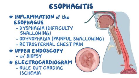 esophagitis definition